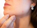 Les appareils anti-acné, la nouvelle solution anti-imperfections !