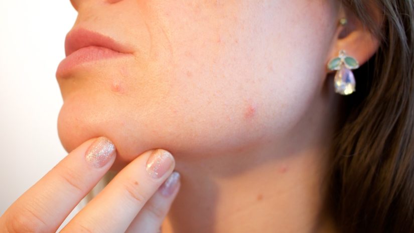 Les appareils anti-acné, la nouvelle solution anti-imperfections !